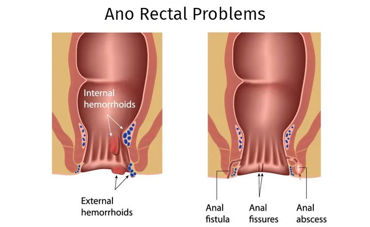 Ano Rectal Problems