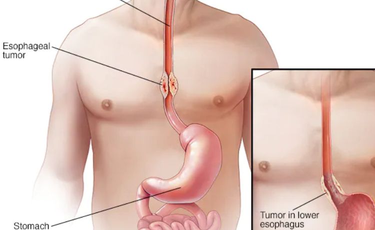 Best Esophageal & Gastric Surgery Doctor, Best Esophageal and Gastric Surgery Doctor, Best Esophageal Stent Doctors in Ahmedabad, Best Esophageal Cancer Doctors in Ahmedabad, Best Esophageal Cancer Doctors in Ahmedabad, Best Esophageal Cancer Doctors in Ahmedabad, Best Esophageal Cancer Doctor in Ahmedabad, Ahmedabad, www.gastrosurgeongujarat.com, www.gastrosurgeongujarat.com/best-esophageal-and-gastric-surgery-doctor.php, Dr. Dhaivat Vaishnav