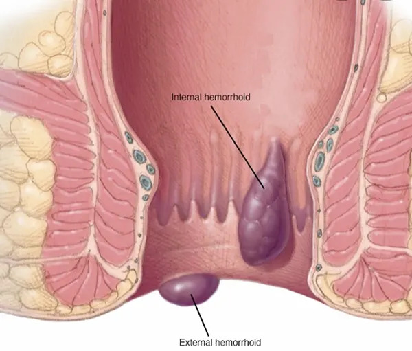 Piles Treatment In Ahmedabad, Piles Surgeon In Ahmedabad, Piles Doctor In Ahmedabad, Piles Treatment In Ahmedabad Gujarat, Piles Treatment In Gujarat, Best Piles Treatment Doctor In Ahmedabad, Best Piles Treatment Doctor In Ahmedabad Gujarat, Best Piles Treatment Doctors In Ahmedabad, Piles Specialist Doctor in Ahmedabad, Doctors for Piles Treatment in Ahmedabad, Best Doctors for Piles Surgery in Ahmedabad, Best Treatment For Piles, Best Piles Treatment Doctor In Ahmedabad, Best Piles Doctors in Ahmedabad, Laser Piles Treatment in Ahmedabad,  Piles Doctor Hospital in Ahmedabad, Fissure and Piles Treatment in Ahmedabad, Ahmedabad, Gujarat, Sarkhej - Gandhinagar Hwy, nr. Sola Bridge, Thaltej, Ahmedabad, Gujarat 380054, 098254 77683, www.gastrosurgeongujarat.com/best-piles-treatment-doctor-in-ahmedabad.php, Gastro Surgeon Gujarat, Dr. Dhaivat Vaishnav