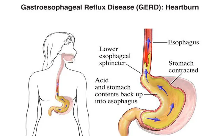 Gastro Esophageal Reflux Disease (GERD): Heartburn