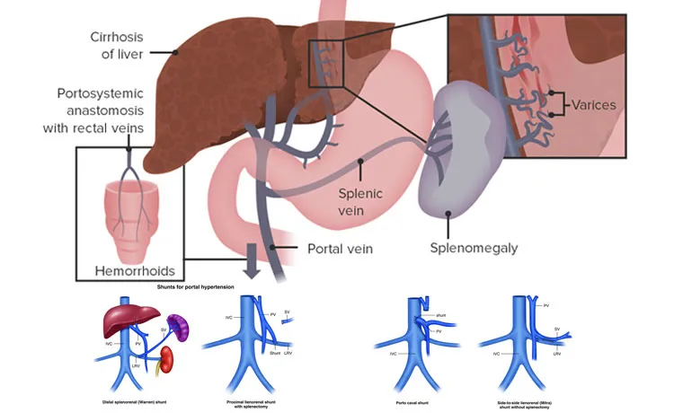 Portal hypertension - splenic surgery